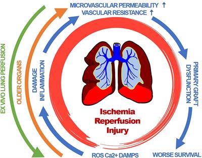 Primary Graft Dysfunction: The Role of Aging in Lung Ischemia-Reperfusion Injury